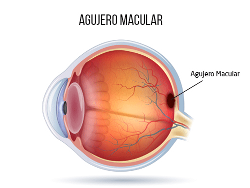 //oftalmologoensaltillo.com.mx/wp-content/uploads/2021/02/agujero-macular1.png