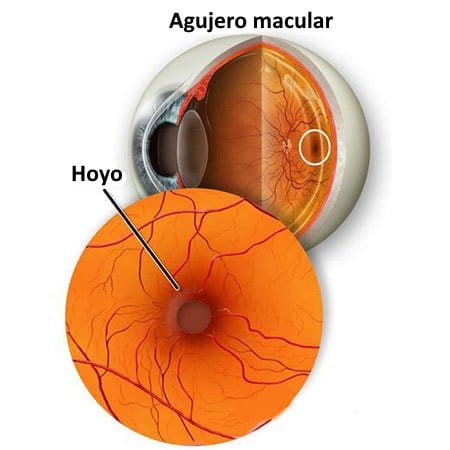 //oftalmologoensaltillo.com.mx/wp-content/uploads/2021/02/macular-hole.jpg
