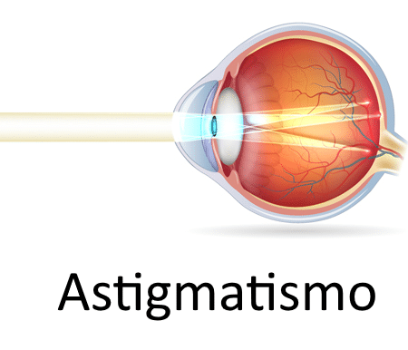 //oftalmologoensaltillo.com.mx/wp-content/uploads/2021/03/ojo-astigmatismo.png