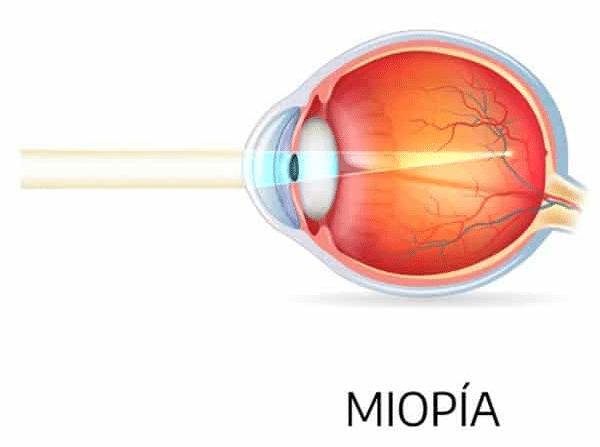 //oftalmologoensaltillo.com.mx/wp-content/uploads/2021/03/ojo-miopia.png
