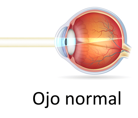 //oftalmologoensaltillo.com.mx/wp-content/uploads/2021/03/ojo-normal.png